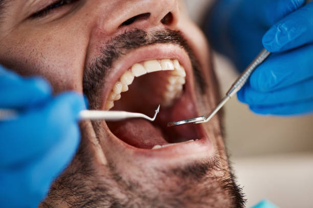 Best Emergency Tooth Extraction in Hideaway, TX
